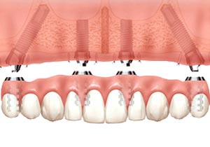 Picture of a dental implants at midwest implant surgery center
