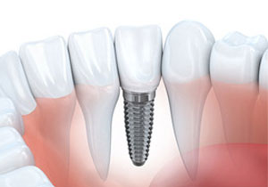 Picture of a dental implant at midwest implant surgery center