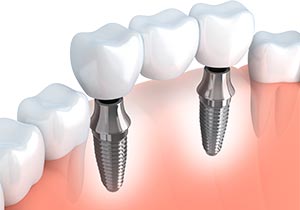 Picture of a dental implant at midwest implant surgery center