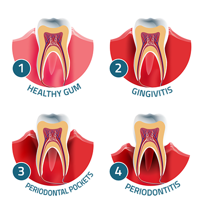 Photo depicting the progression of gum disease