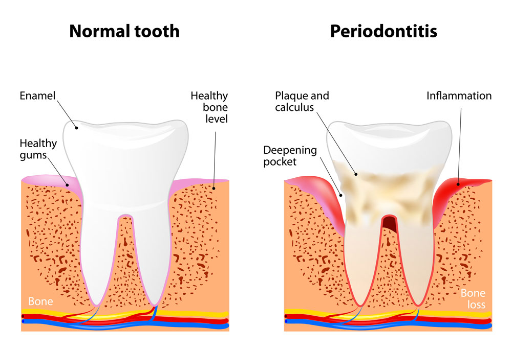 Diagram of a healthy tooth and one that has peridontitis