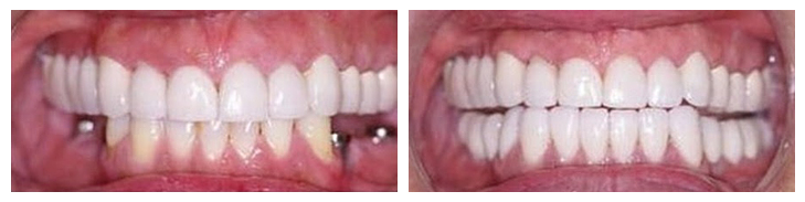 Smile Gallery : Before and after photos of dental implants Midwest Implant Surgery Center