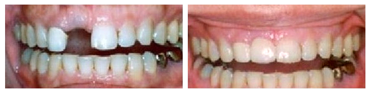 Smile Gallery : Before and after photos of dental implants Midwest Implant Surgery Center
