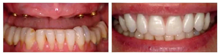 Smile Gallery : Before and after photos of dental implants Midwest Implant Surgery Center