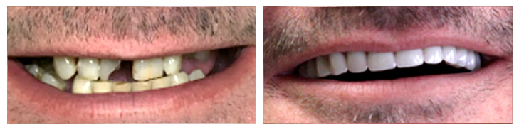 Before and after photos of dental implants Midwest Implant Surgery Center