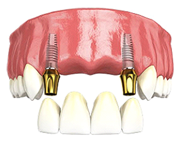 Dental-implant-img-multi