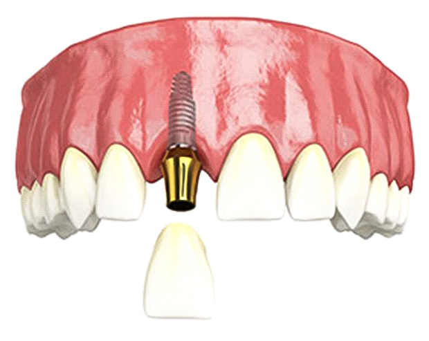 Dental-implant-img-single