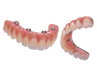 Implant Supported Dentures/Bridges, "All-on-X"