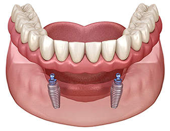 "Snap-in" Implant Retained Dentures